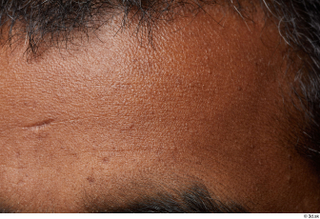 HD Face Skin Ciawi Jianguo face forehead scar skin pores…
